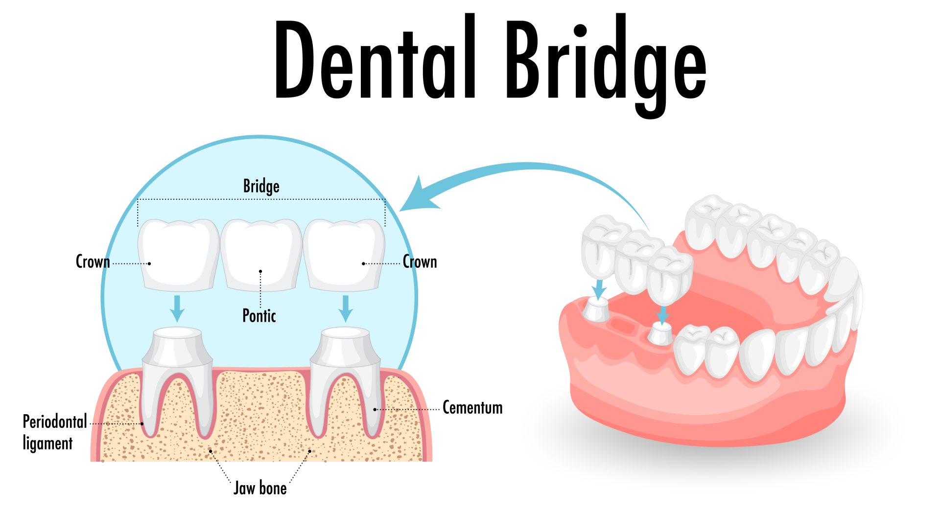 dental bridges in toronto