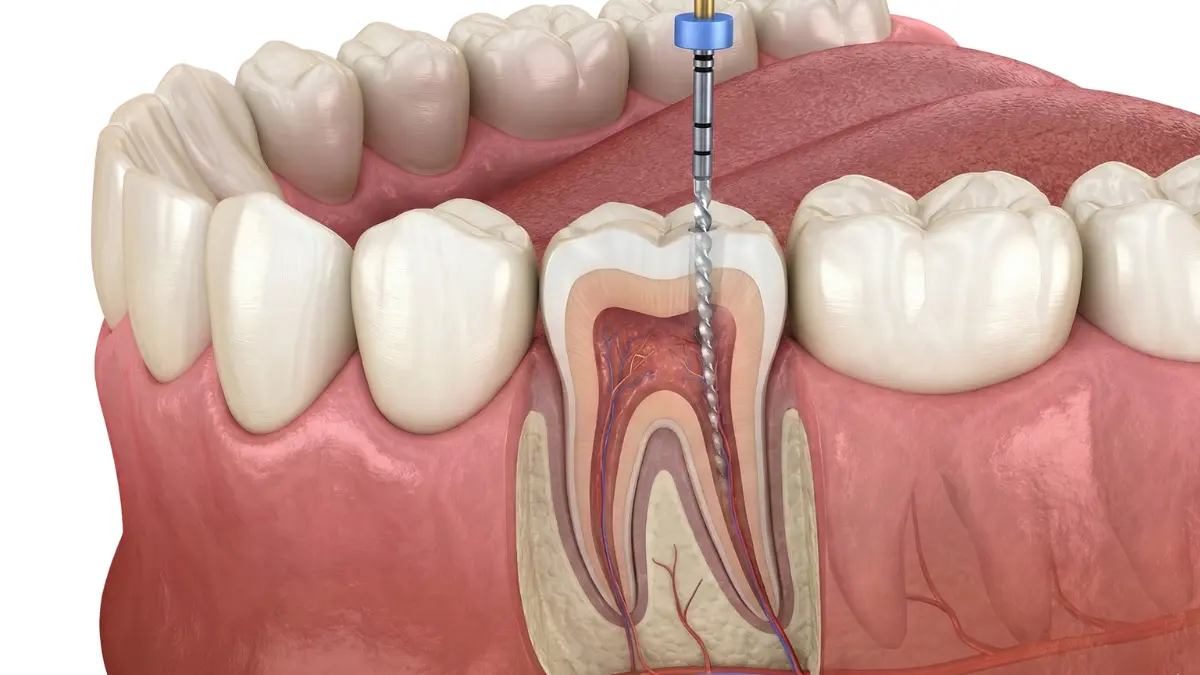 Root Canal Treatment in Toronto
