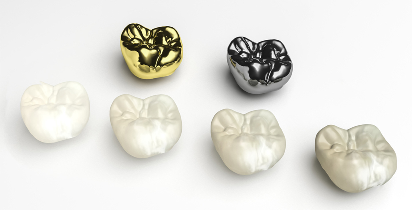 dental crowns in toronto