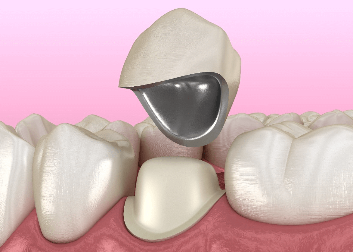 dental crowns in toronto