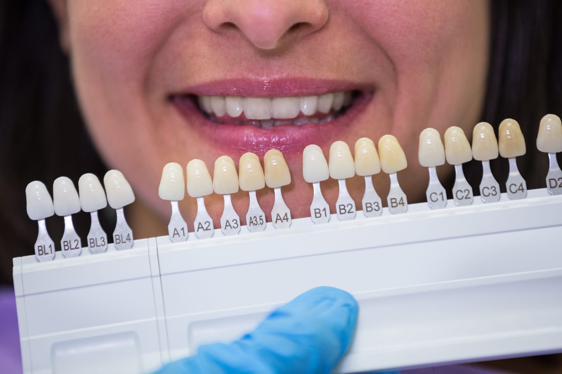 dental veneer in toronto