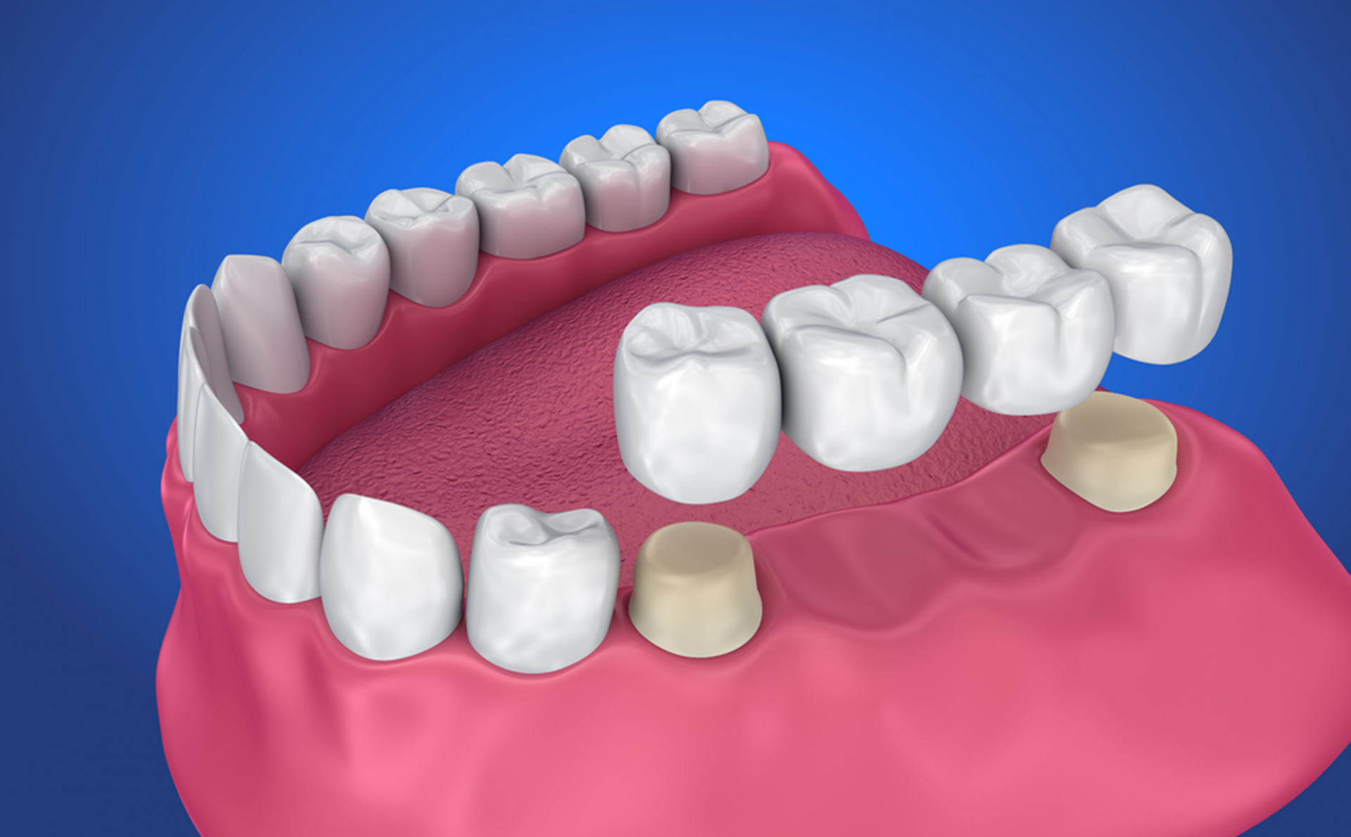how to fix your smile using dental bridges