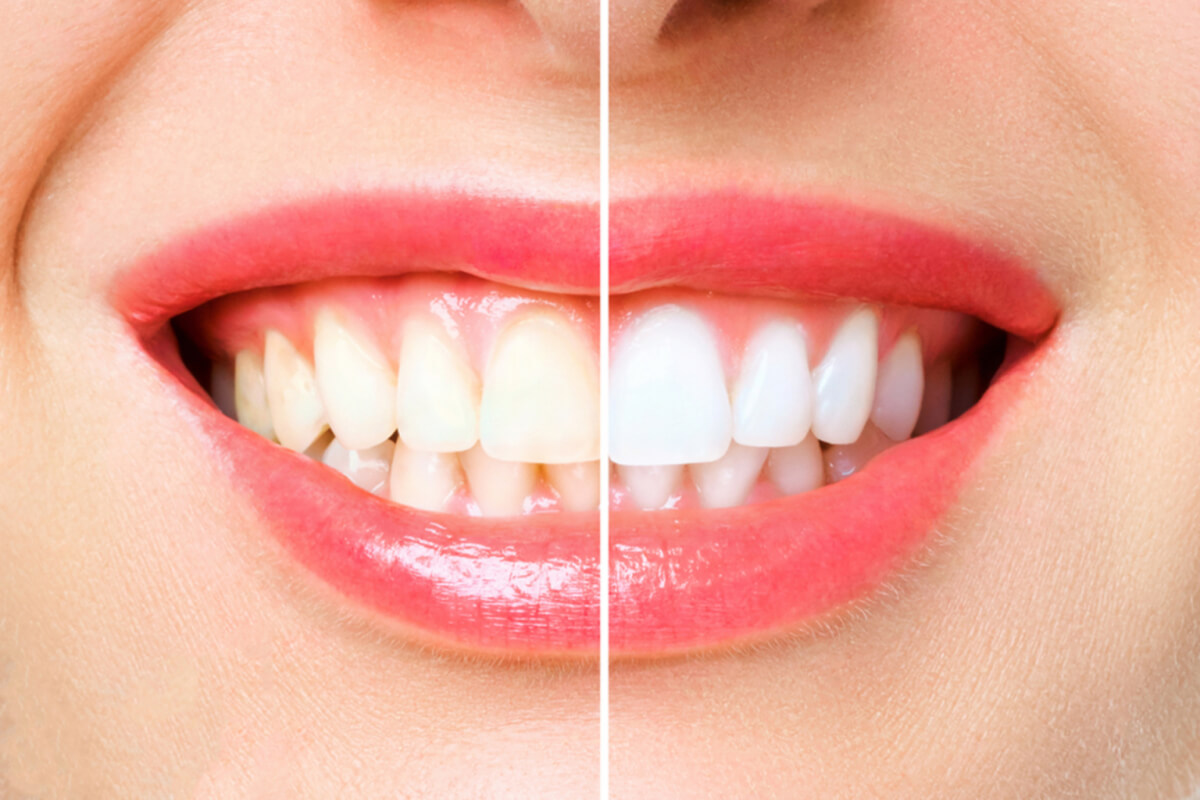 all you should know about phillips zoom teeth whitening