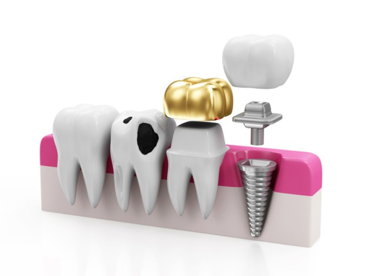 everything you need to know about dental crowns