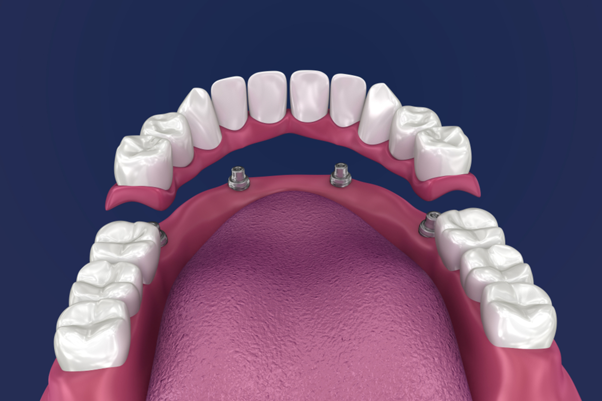 what are the four types of permanent dentures available right now