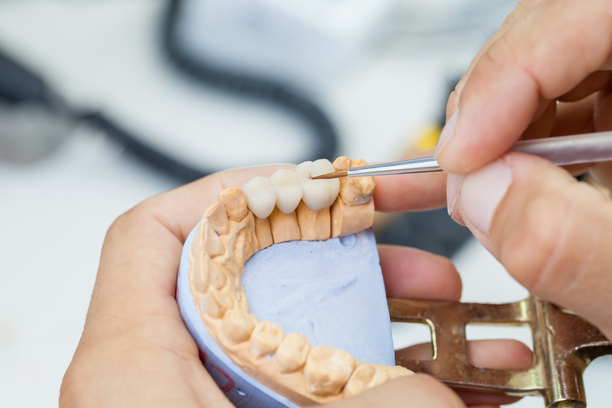 everything you need to know about dental bridges