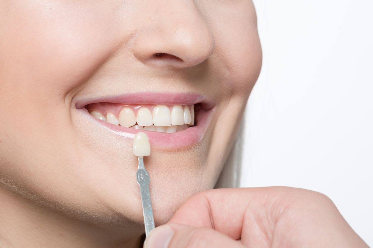 smile makeover magic: closing tooth gaps with dental veneers