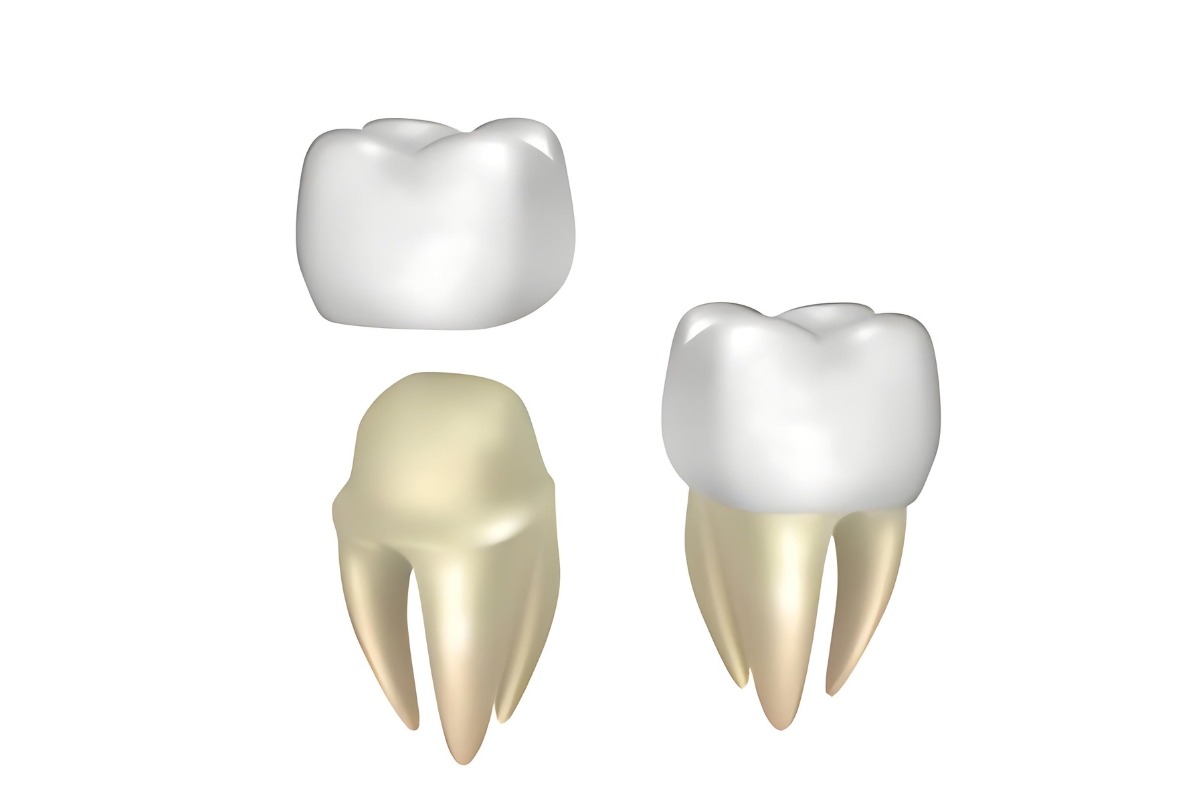 What are the benefits of timely crown replacement