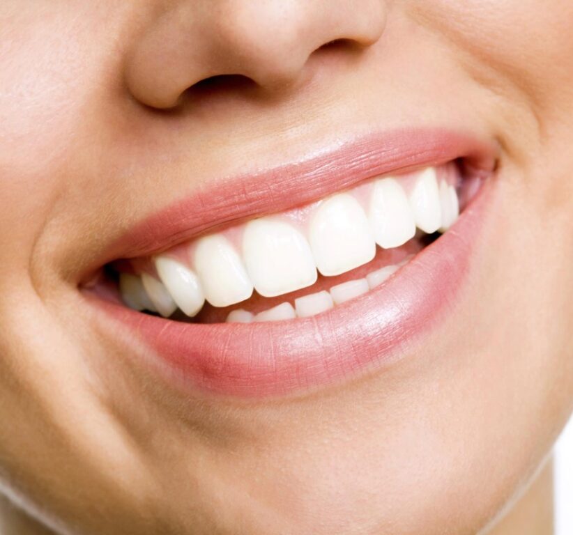 professional teeth whitening vs drugstore kits
