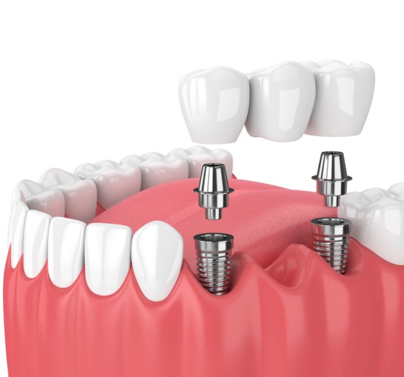 long does a dental bridge last, and how much does it cost