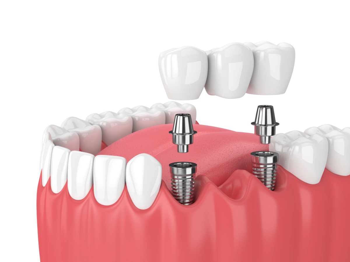 long does a dental bridge last, and how much does it cost