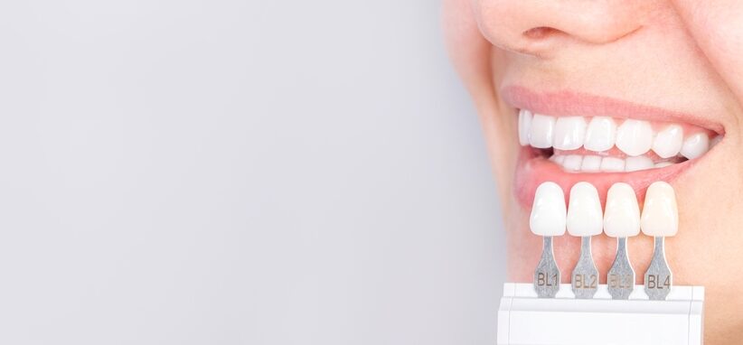 dental veneers on teeth
