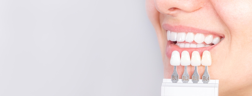 dental veneers on teeth