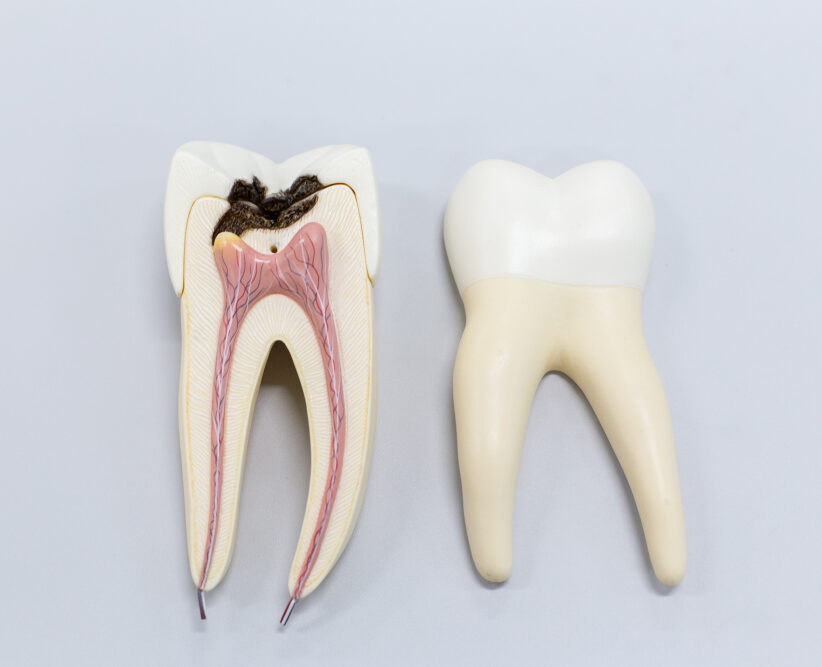 root canal treatment cost