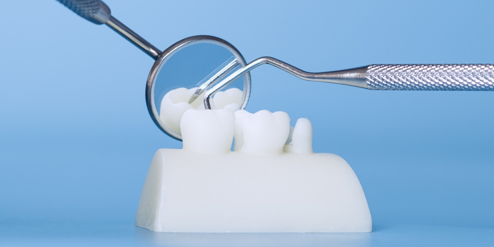 dental bridges, and how do they work