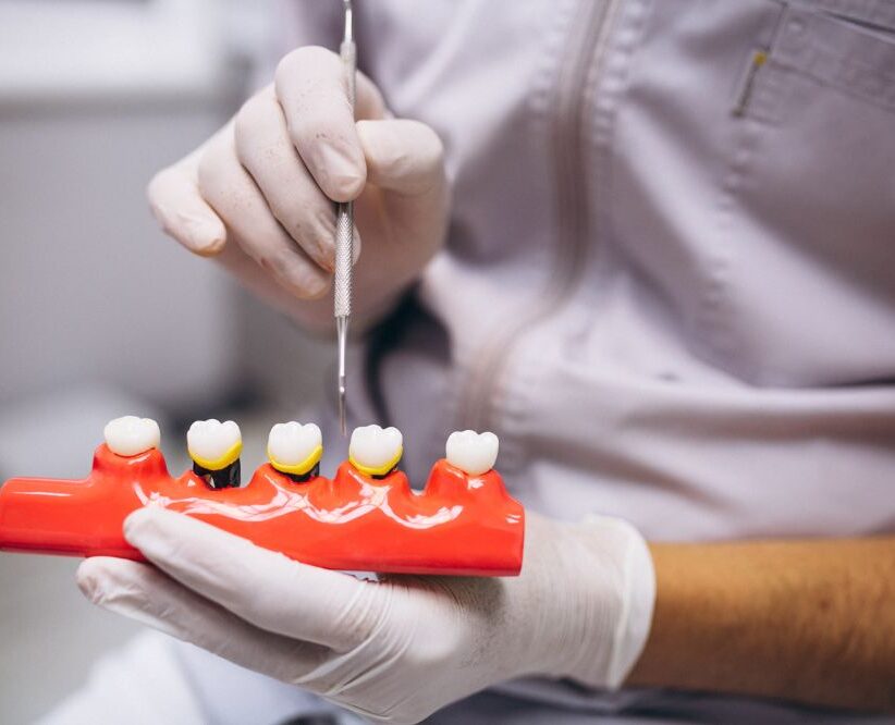 Dentist demonstrating dental crown placement on a tooth model using a dental instrument in a clinic setting.